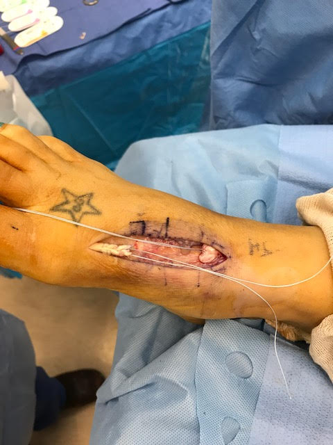 Figure 5 for case Extensor hallucis longus tendon ( RID3188 ) laceration